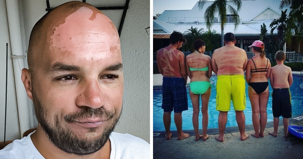 17 фотографий людей, которые не воспринимали солнце всерьёз — и оно их за это как следует наказало