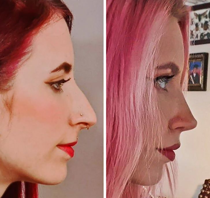 18 человек рассказали, чем обернулась для них пластика, о которой они так мечтали