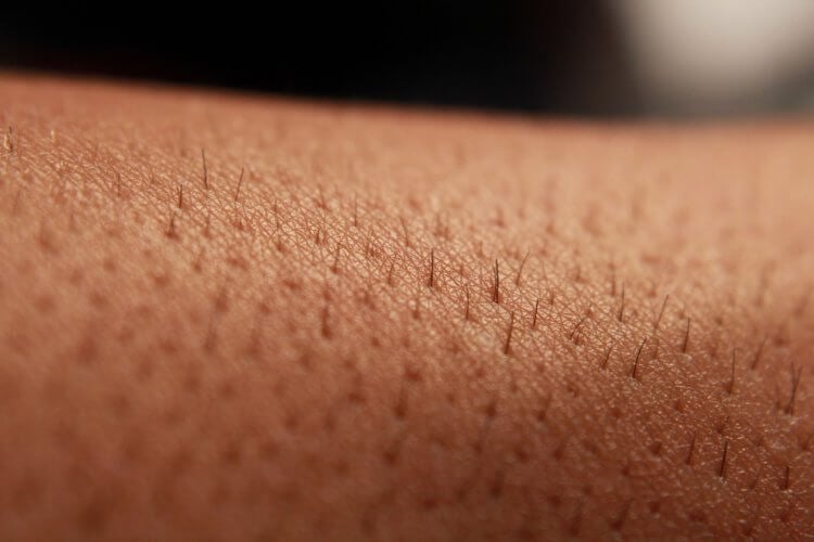 Контагиозный моллюск — лечение и симптомы. Раньше контагиозный моллюск также был известен как оспенноподобное акне. Фото.