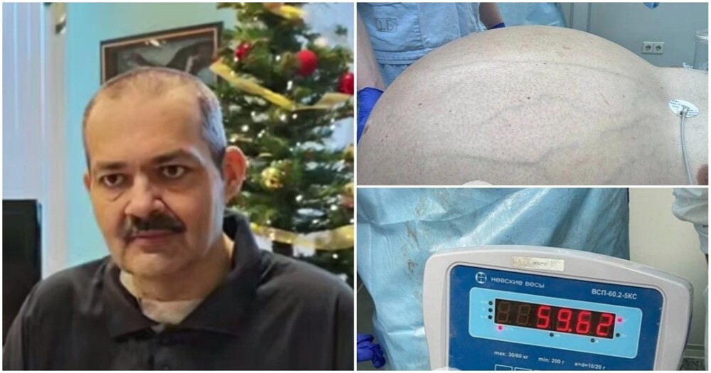 Мужчине удалили опухоль весом более 60 килограммов