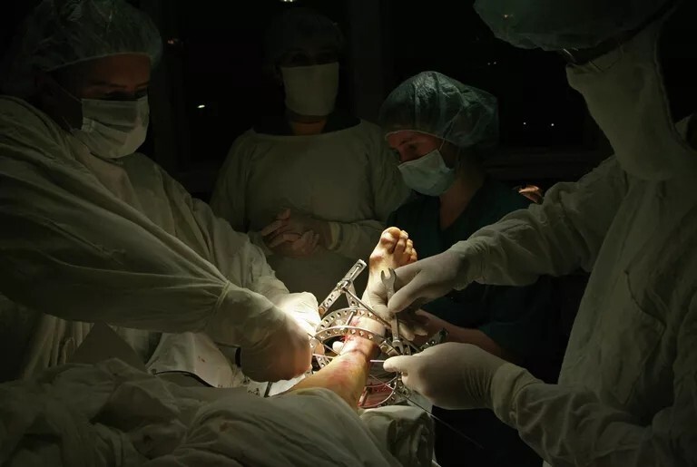 Хирурги проводят операцию по установке аппарата доктора Илизарова на травмированную стопу Хирурги проводят операцию по установке аппарата доктора Илизарова на травмированную стопу